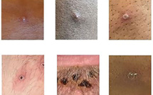 Variole du singe: plus de 5.000 cas confirmés (OMS)