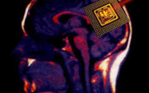 Progrès vers un implant dans le cerveau pour restaurer la mémoire