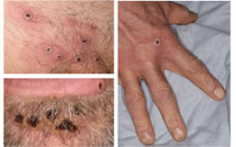 Un cas de variole du singe détecté en Nouvelle-Calédonie