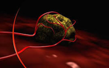 USA: un cancer guéri par une dose massive de virus modifiés de la rougeole