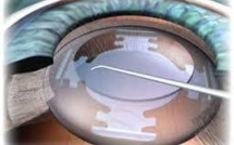 Cataracte: les ophtalmologues craignent une chirurgie au rabais