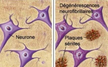 Un diagnostic précoce et simplifié de la maladie d'Alzheimer