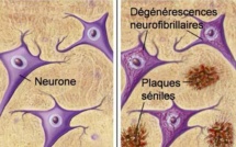 Un diagnostic précoce et simplifié de la maladie d'Alzheimer