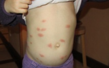 Chikungunya : comment remobiliser la population antillaise contre l'épidémie