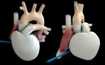 Coeur artificiel Carmat: le deuxième patient opéré "va bien", selon le chirurgien