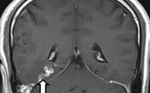 GB: un ver dans le cerveau à l'origine des maux de tête d'un patient
