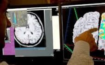 Le Big Data espoir dans la lutte contre Alzheimer