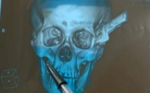 Brésil : un couteau dans la tête, il voyage 100 km jusqu'à l'hôpital