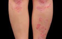 Les gens atteints de psoriasis victimes de discriminations