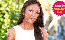 Nouvelle opération chirurgicale pour Turia Pitt
