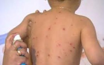 La rougeole peut affaiblir le système immunitaire des enfants pendant 3 ans