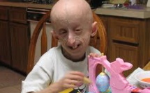 Vieillissement précoce : des chercheurs réparent des cellules malades