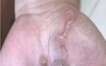 4 cas de larva migrans