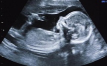 Chili: une femme de 92 ans porteuse d'un foetus momifié