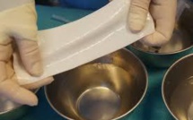 Implants: interdiction d'un produit pour la reconstruction mammaire