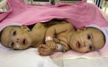 Des bébés siamois afghans séparés avec succès à Kaboul