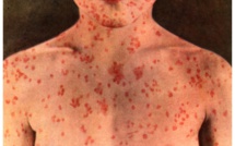 Rougeole: 320 morts et 20.000 contaminés en RDC depuis janvier (ONU).