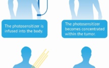 Stratégie révolutionnaire contre le cancer agressif