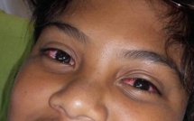 L'épidémie de conjonctivite se stabilise sur le fenua