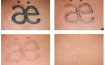 En tatouages comme en amours, des erreurs qui font mal