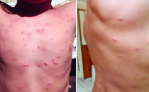 Deux cas de dermatite du surfeur signalés à Papara