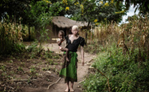 Assassinats d'albinos: le Malawi interdit les sorciers et guérisseurs traditionnels
