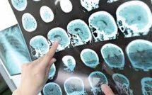 Un traitement à haut risque pourrait stopper la sclérose en plaques