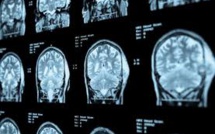 Un haut niveau d'études serait associé à un risque accru de tumeurs du cerveau