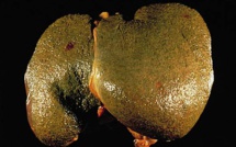 La cirrhose du foie, mal connue des Français