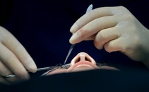 Italie: une femme aveugle recouvre la vue après une greffe inédite