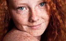 Le risque de cancer de la peau possiblement accru par un gène chez les roux